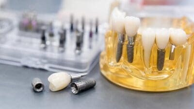 Durchsichtiges Modell eines Kiefers mit mehreren Zahnimplantaten und weißen Kronen auf grauer Unterlage